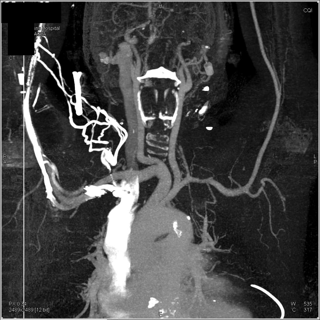CTA with MIP and Bone Removal - CTisus CT Scan
