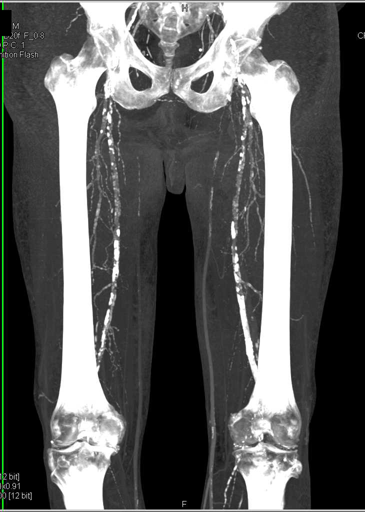 Extensive Peripheral Vascular Disease on CTA Runoff - CTisus CT Scan