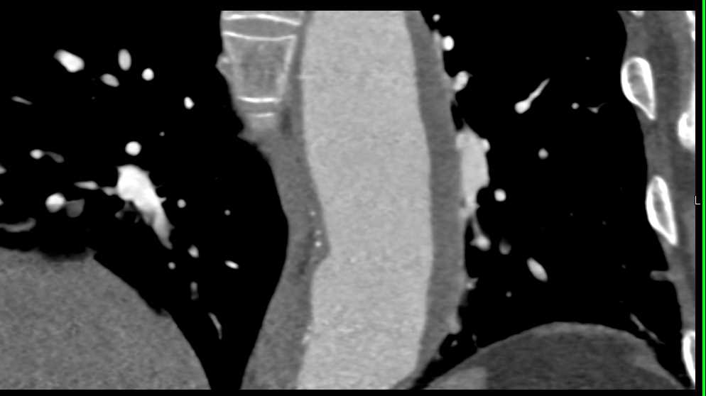 Mycotic Abdominal Aortic Aneurysm - CTisus CT Scan