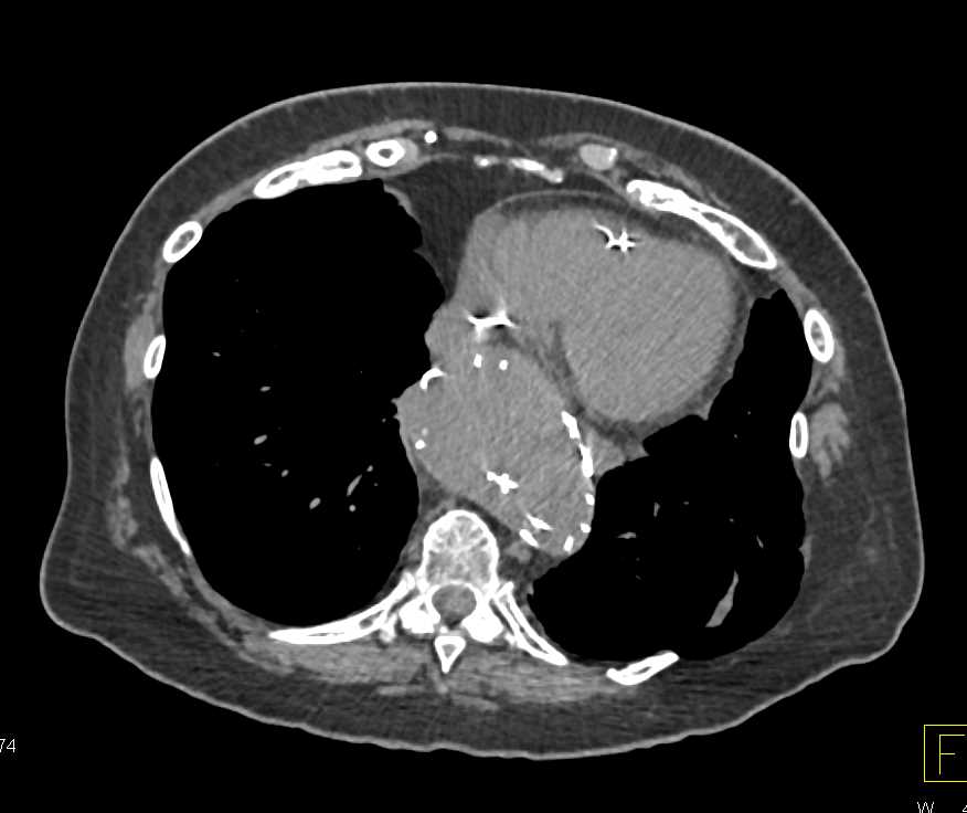 Fibromuscular Dysplasia Both Renal Arteries in a Patient with an Endovascular Stent and Endoleak - CTisus CT Scan