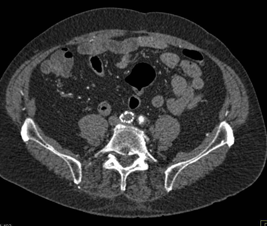 Occluded Stent in Right Iliac Artery with Fem-Fem Bypass Graft - CTisus CT Scan