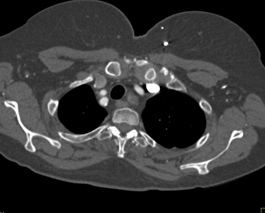 Endovascular Stent with Endoleak - CTisus CT Scan