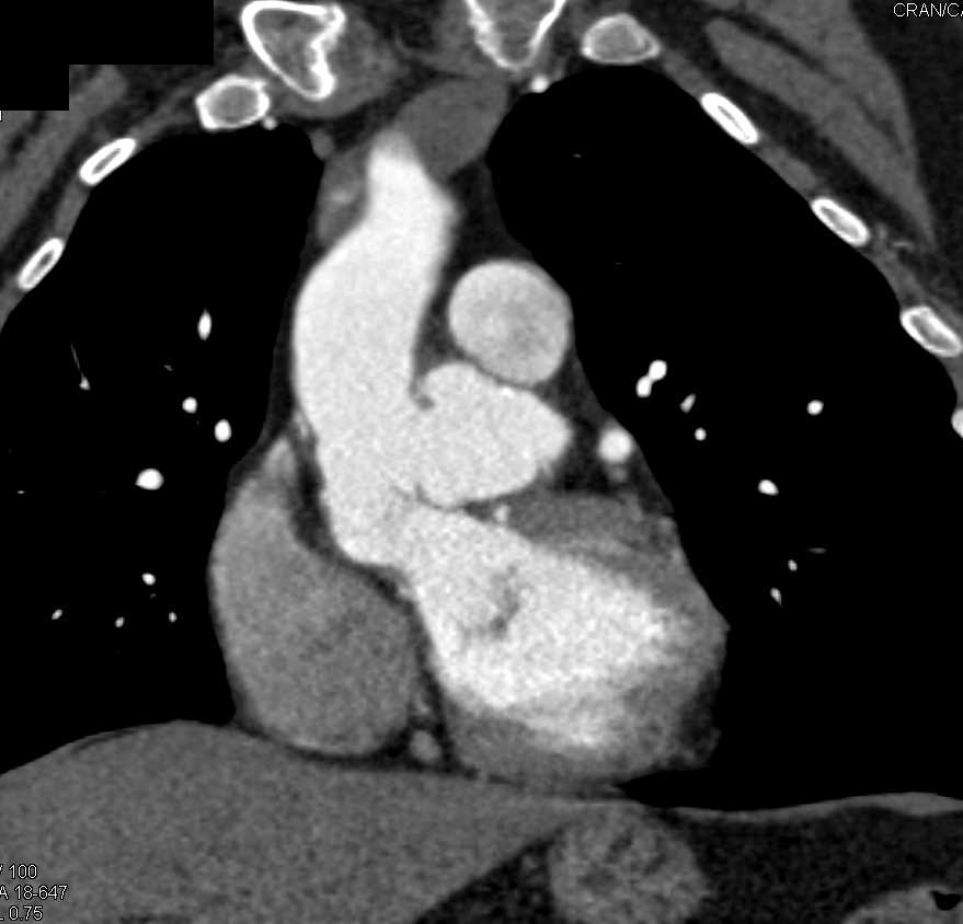 Pseudoaneurysm off the Ascending Aorta Amongst Numerous Vascular Pathologies - CTisus CT Scan