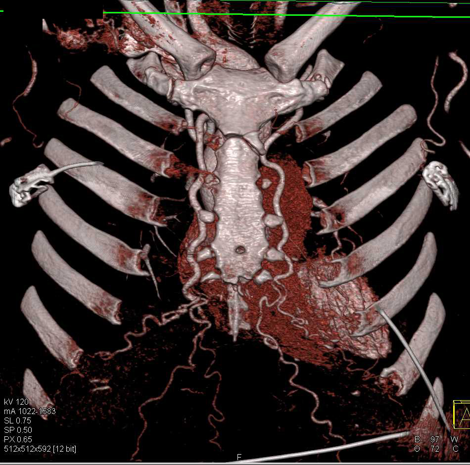 Coarctation of the Aorta with Collaterals Best Seen on the Sagittal Views - CTisus CT Scan
