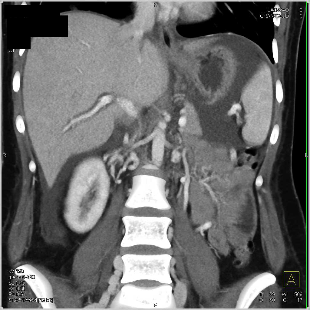 Inferior Vena Cava (IVC) Occlusion with Extensive Collaterals - CTisus CT Scan
