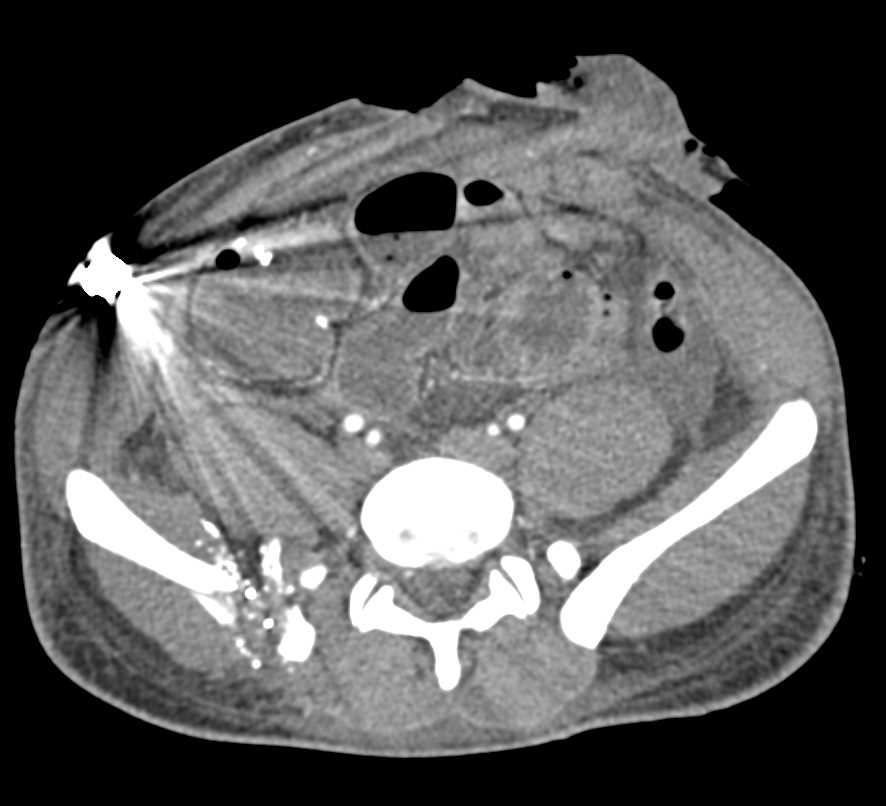 Gunshot Wound with Multiple Fractures but no Vascular Injury - CTisus CT Scan