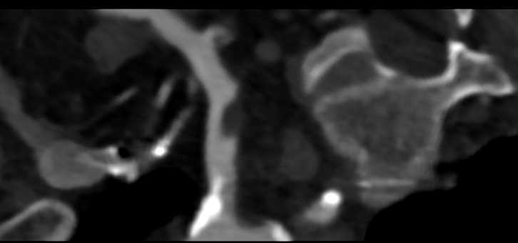 Subclavian Artery Stenosis with Plaque in Right Subclavian Artery - CTisus CT Scan