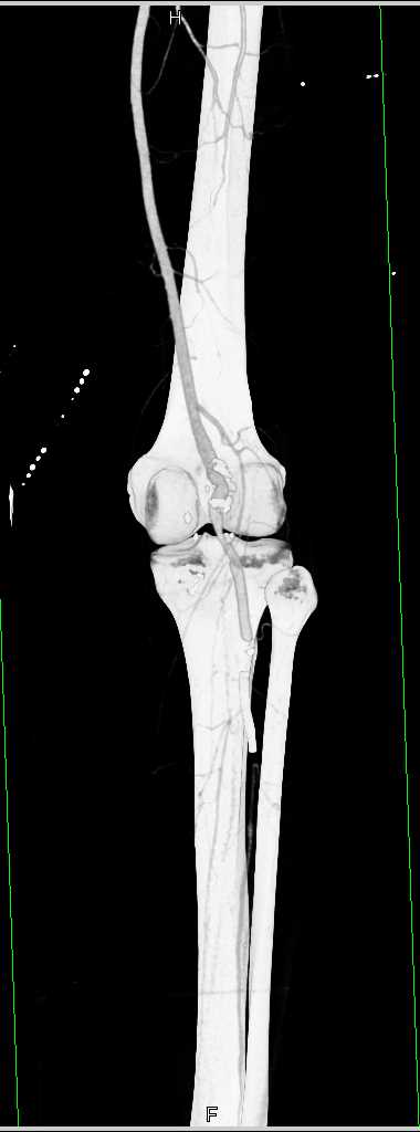 Popliteal Artery Aneurysm - CTisus CT Scan