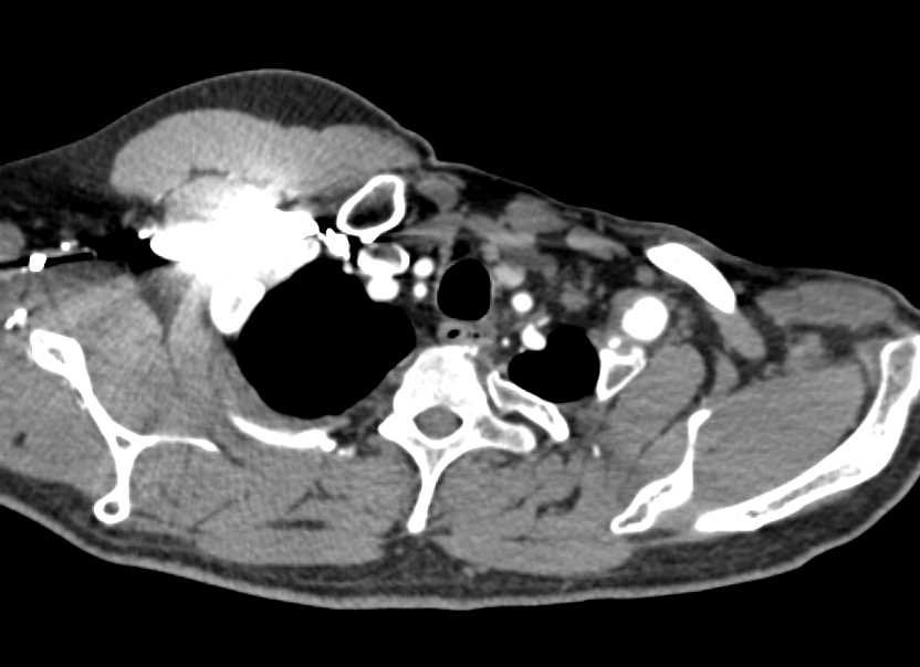Left Subclavian Artery Aneurysm - CTisus CT Scan
