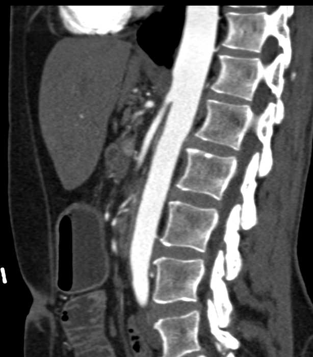 Superior Mesenteric Artery (SMA) Syndrome with Narrowed SMA Angle and Dilated Proximal Duodenum - CTisus CT Scan