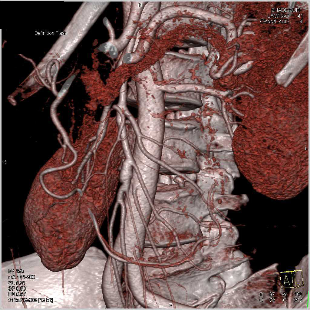 Superior Mesenteric Artery (SMA) Aneurysm on a CTA - CTisus CT Scan