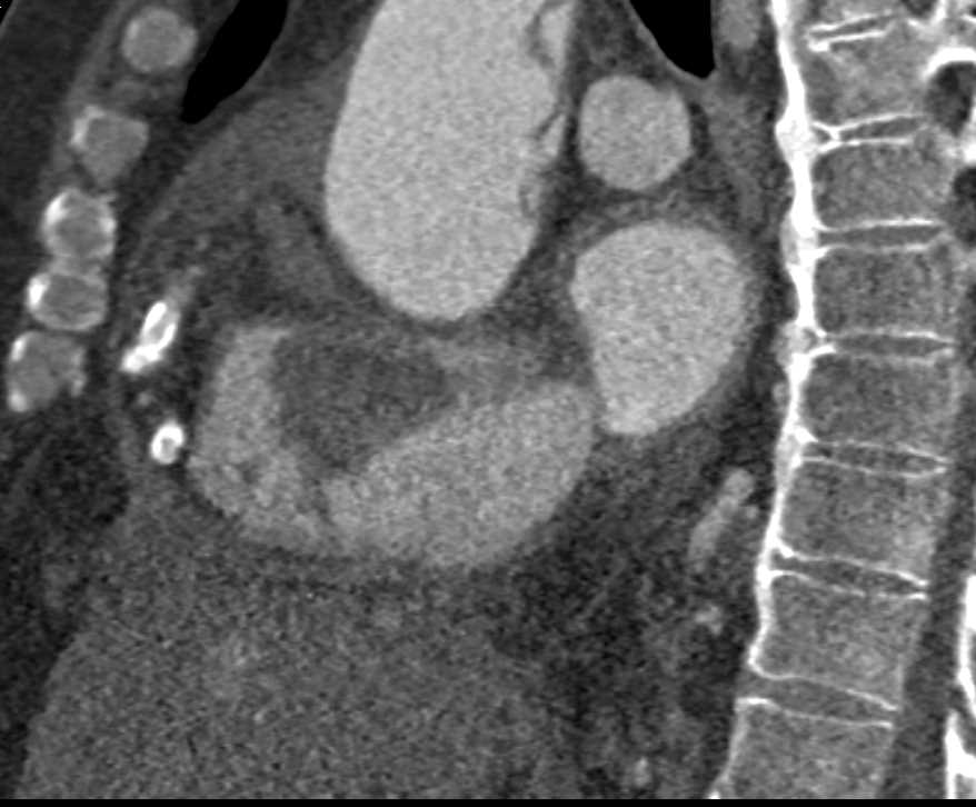 Type A Dissection - CTisus CT Scan