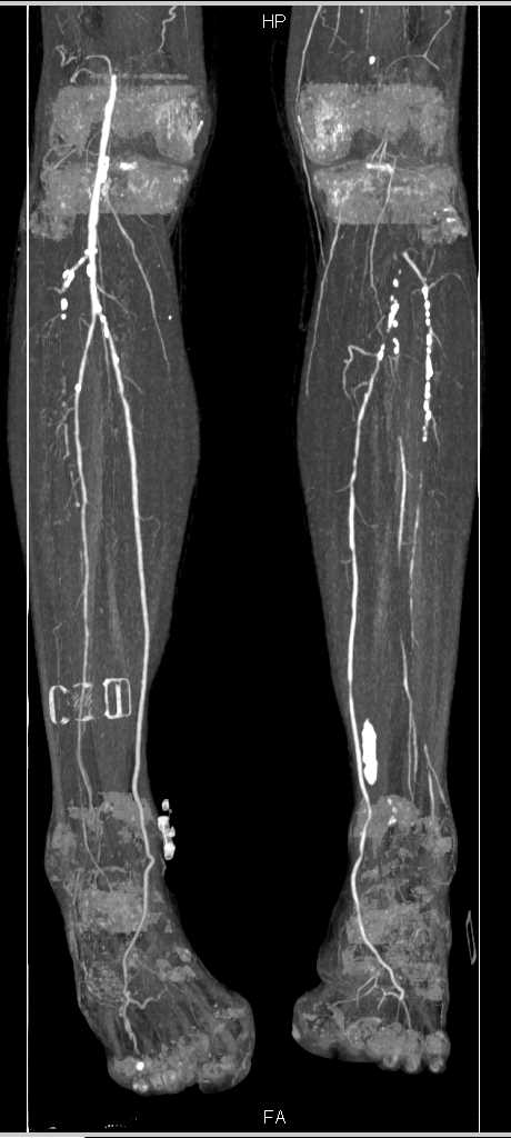 CTA Runoff with Bilateral Peripheral Vascular Disease (PVD) - CTisus CT Scan