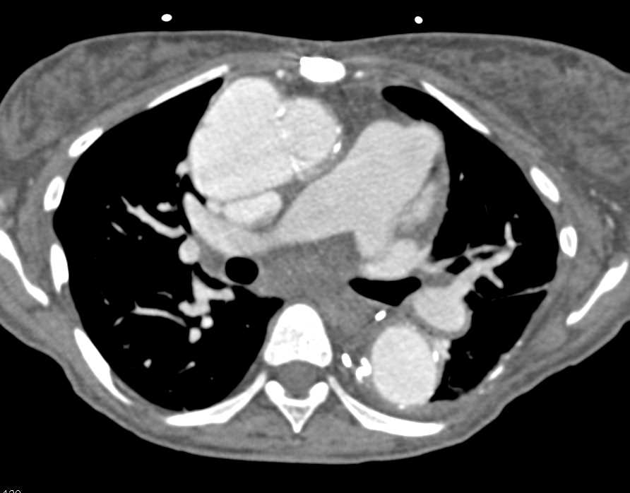 Pseudoaneurysm  Ascending Aorta s/p Repair - CTisus CT Scan