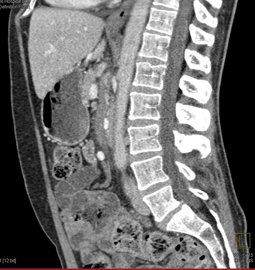 Superior Mesenteric Artery (SMA) Occlusion Best Seen on the Sagittal View - CTisus CT Scan