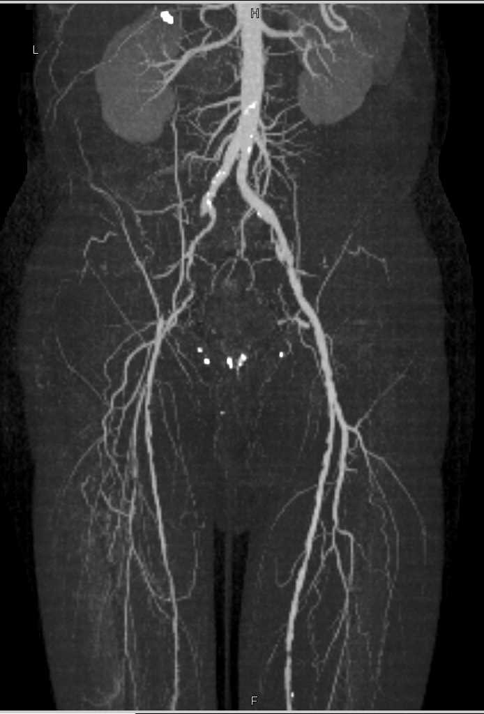 CTA Runoff with Occluded Right Superficial Femoral Artery (SFA) and Peripheral Vascular Disease (PVD) - CTisus CT Scan