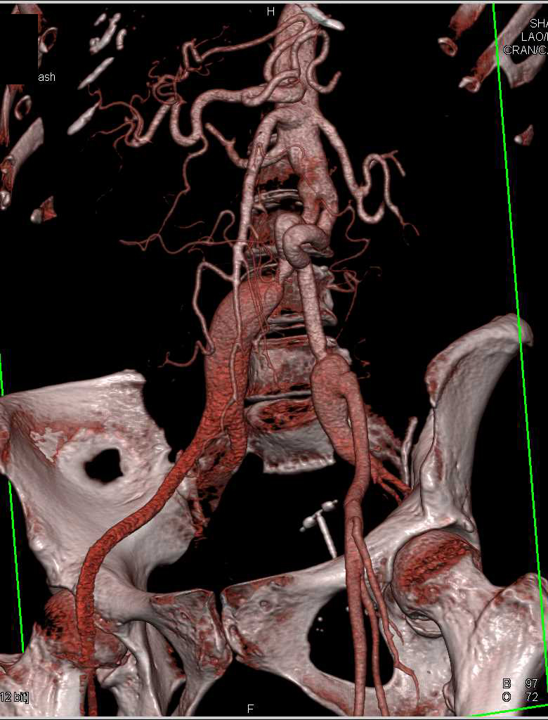 Ehlers-Danlos Syndrome with Multiple Aneurysms - CTisus CT Scan