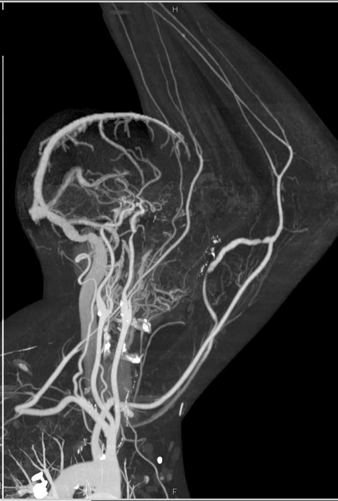 CTA Vascular Mapping of the Upper Extremity - CTisus CT Scan