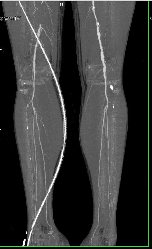 Superficial Femoral Artery (SFA) Occlusion with Severe Peripheral vascular Disease - CTisus CT Scan