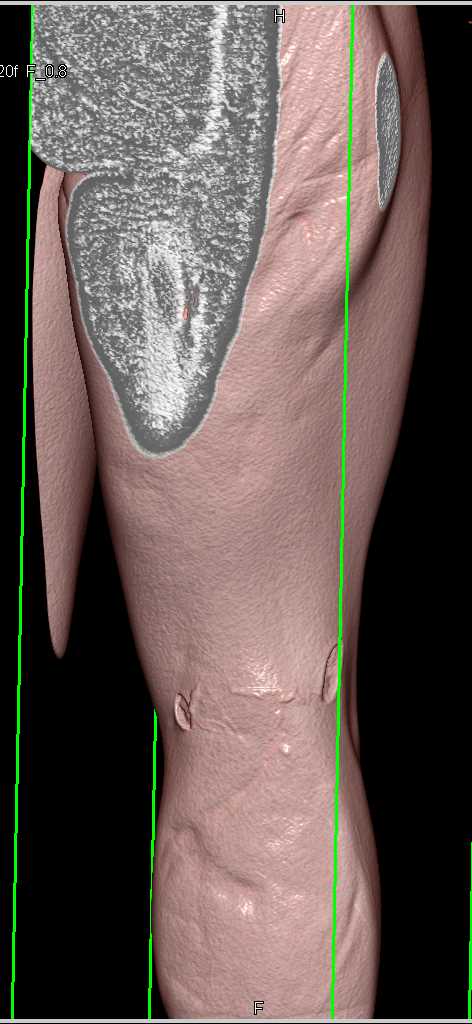 Stab Wound Calf Without Vascular Injury - CTisus CT Scan