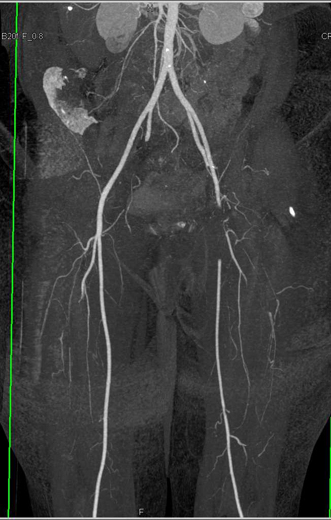 Acute Occlusion Left Femoral Artery and Right Renal Infarcts - CTisus CT Scan