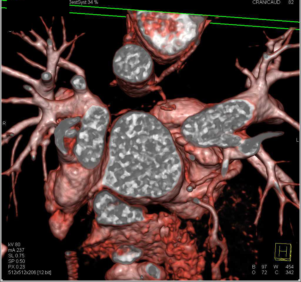 Corrected Transposition of the Great Vessels with Anterior Pulmonary Artery - CTisus CT Scan