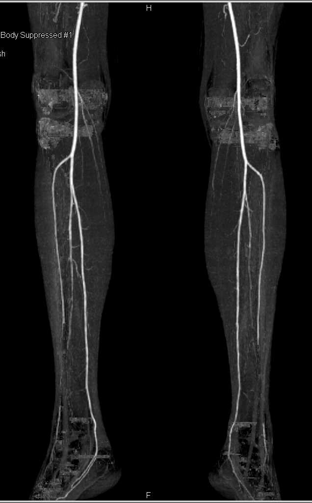 Multisite Vascular Disease in Both Lower Extremities - CTisus CT Scan