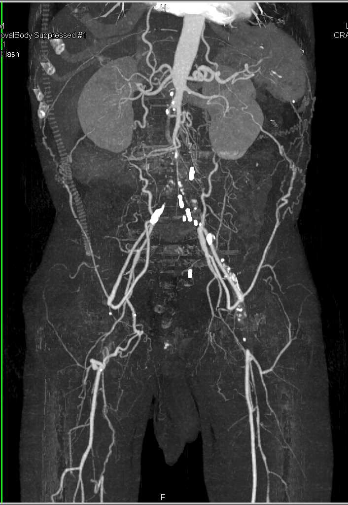 Bilateral Superficial Femoral Artery (SFA) and Iliac Artery Occlusion - CTisus CT Scan
