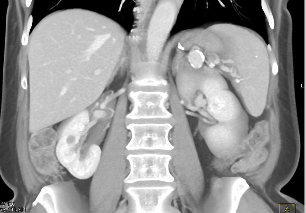 Splenic Artery Aneurysms - CTisus CT Scan