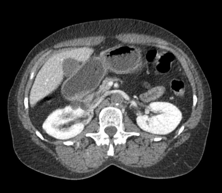 Occlusion of Infrarenal Abdominal Aorta with Reconstitution of Flow to the Lower Extremities - CTisus CT Scan