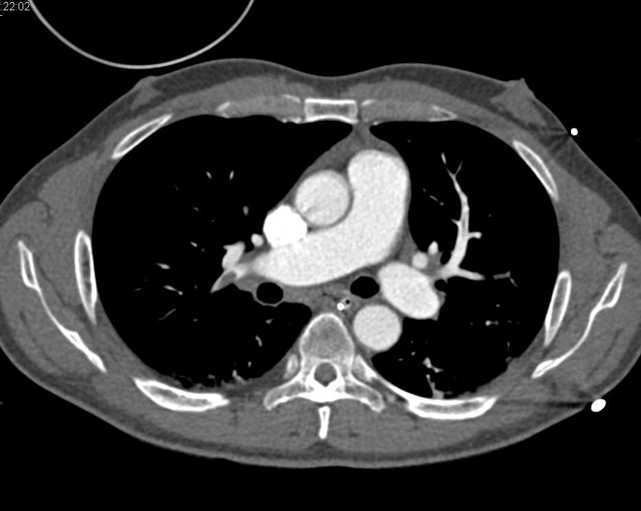 Superior Mesenteric Artery (SMA) Thrombi and Pulmonary Embolism - CTisus CT Scan