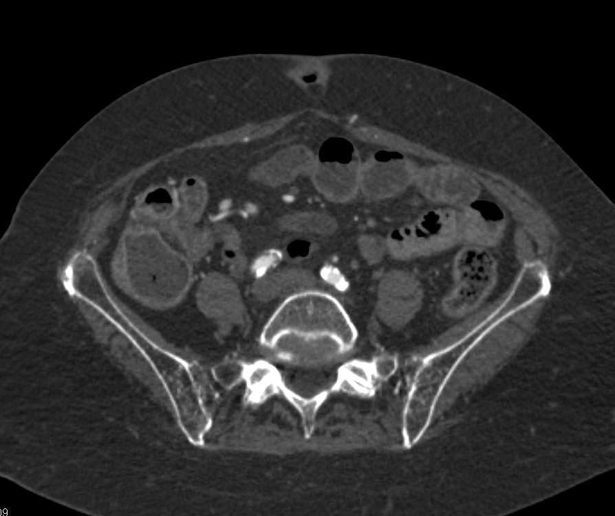 CTA Runoff with PVD (Peripheral Vascular Disease) - CTisus CT Scan