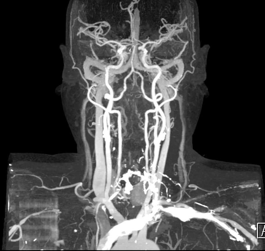 CTA of the Neck with Dual Energy Bone Removal - CTisus CT Scan