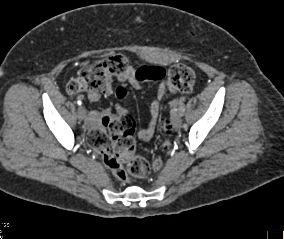 CTA Runoff with Occlusion of the Left External Iliac Artery - CTisus CT Scan