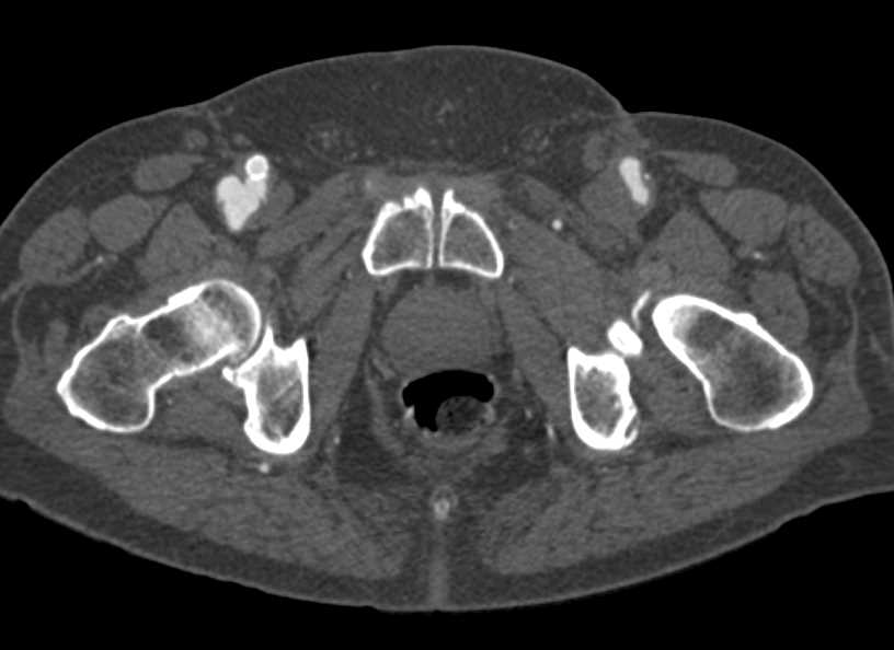 Occluded Stent off the Femoral Artery on the Right - CTisus CT Scan