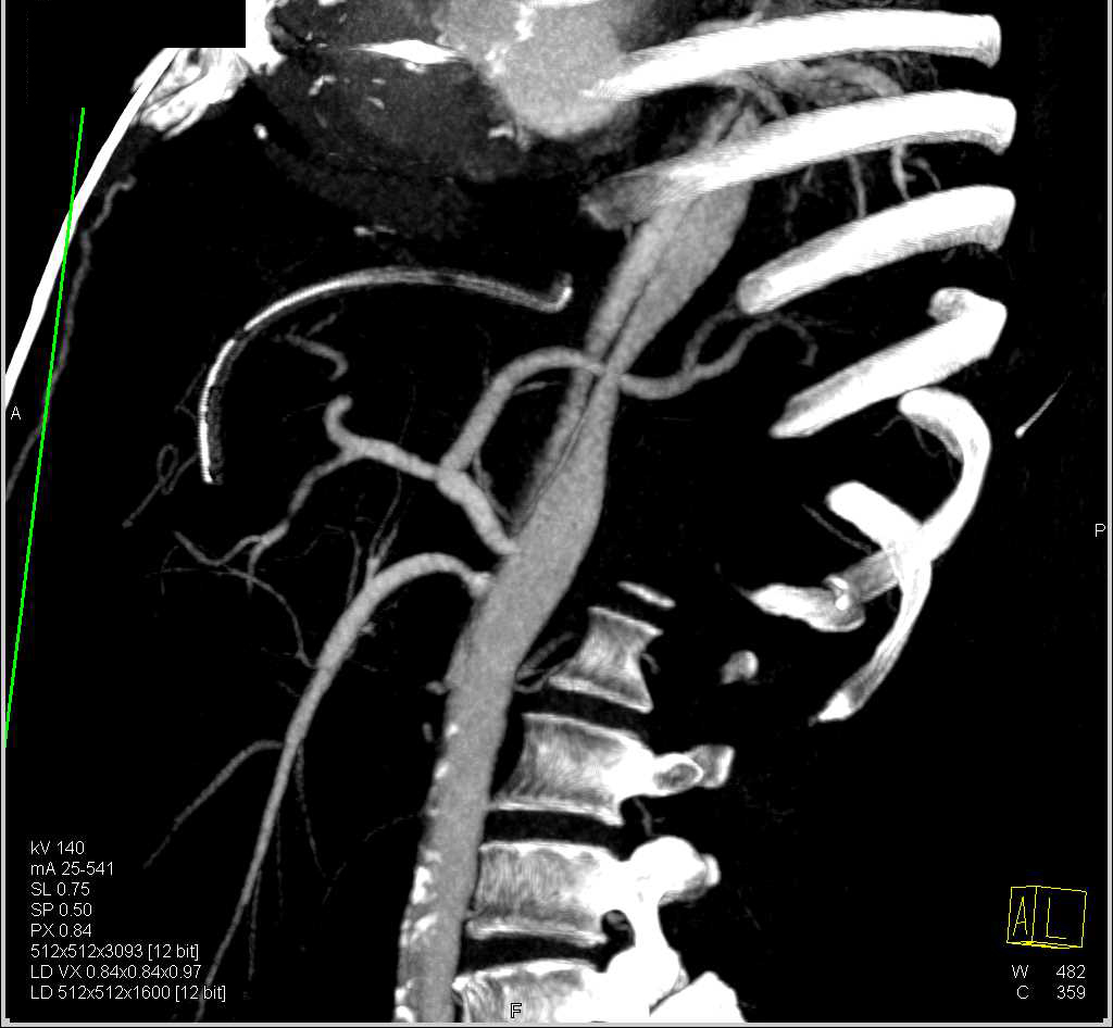 Type A Dissection Extends Through the Iliac Arteries - CTisus CT Scan