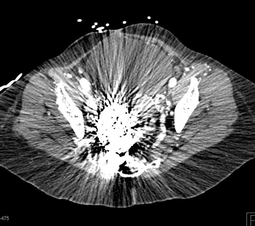 Large Pelvic Arteriovenous Malformation (AVM) with Prior Embolization and Remaining AVM - CTisus CT Scan