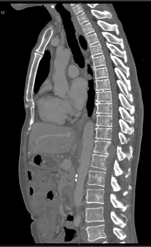 Iliac Artery Occlusion on the Right with DE CTA - CTisus CT Scan