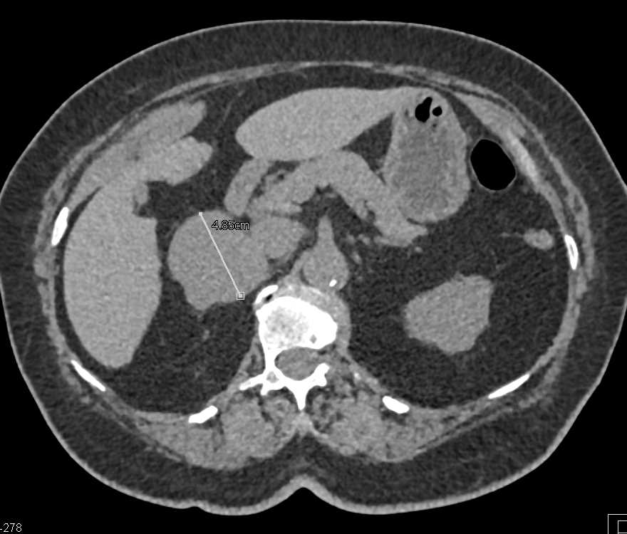 Mesenteric Mass - CTisus CT Scan