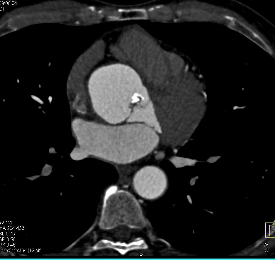 Aortic Valve Leaflet Calcification with Aortic Stenosis - CTisus CT Scan