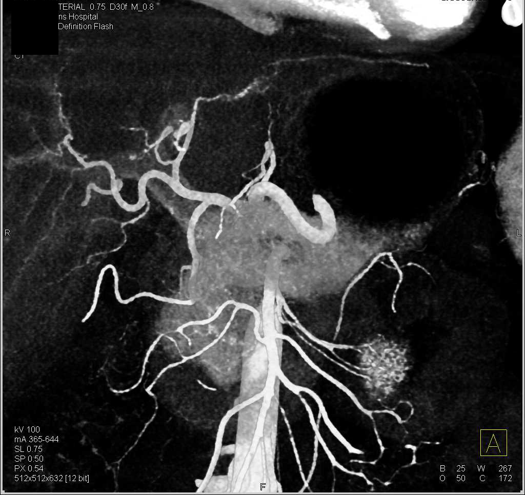 CTA of Mesenteric Vessels - CTisus CT Scan