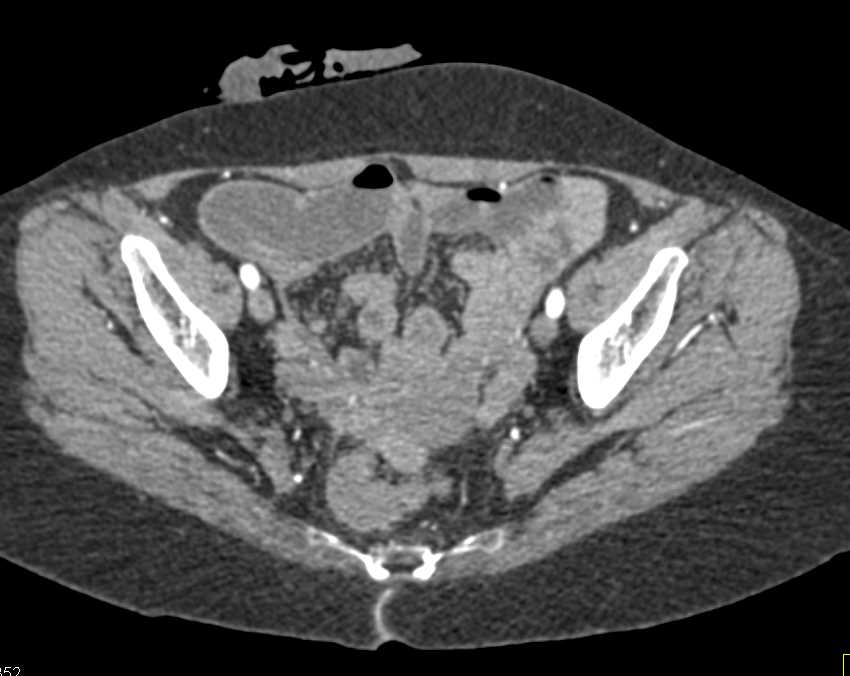 Prominent Rectal Vessels - CTisus CT Scan