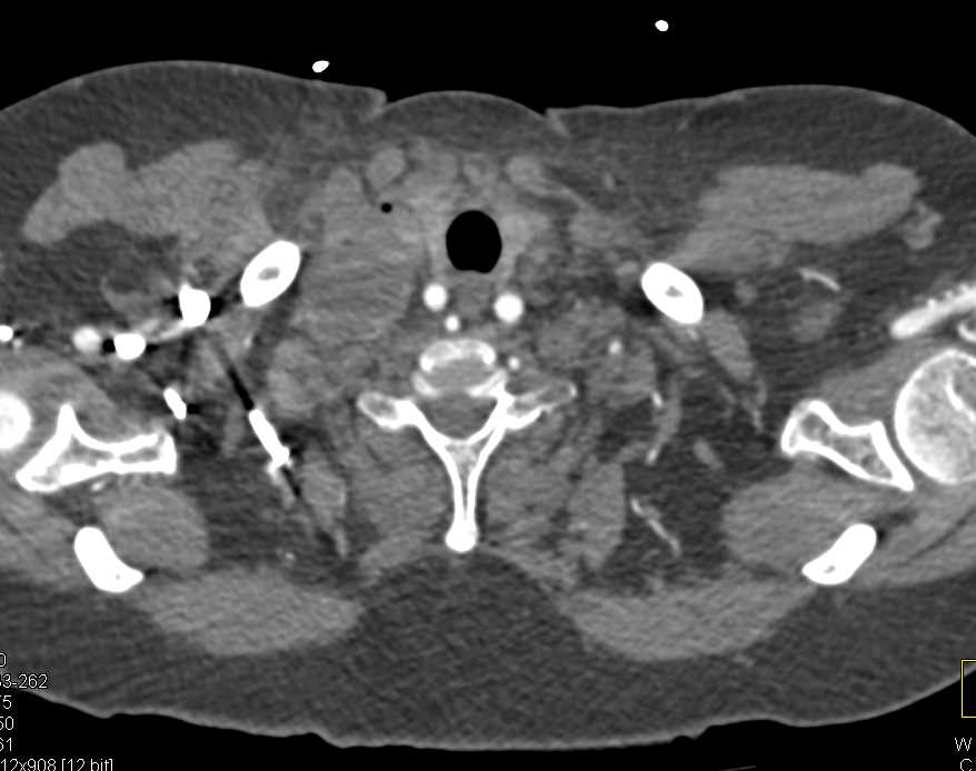Superior Vena Cava (SVC) Syndrome due to Small Cell Lung Cancer - CTisus CT Scan