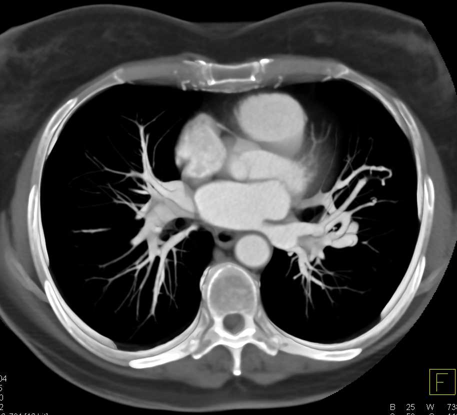 Pulmonary Arteriovenous Malformation (AVM) in 3D - CTisus CT Scan