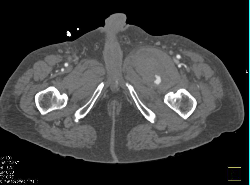 CTA with Active Bleed in the Left Thigh - CTisus CT Scan