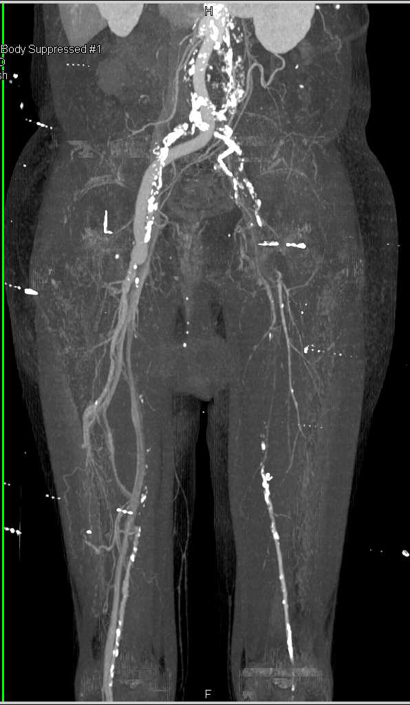 Left Iliac Artery Occluded on CTA - CTisus CT Scan