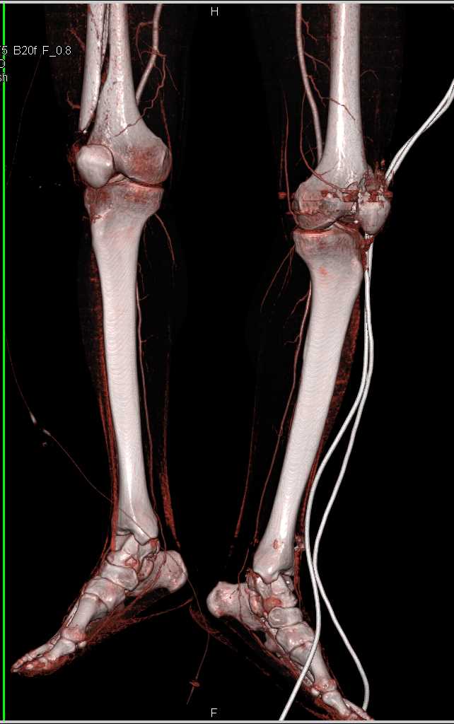 Femur Fractures Without Vascular Injury as Shown by Dual Energy Datasets - CTisus CT Scan
