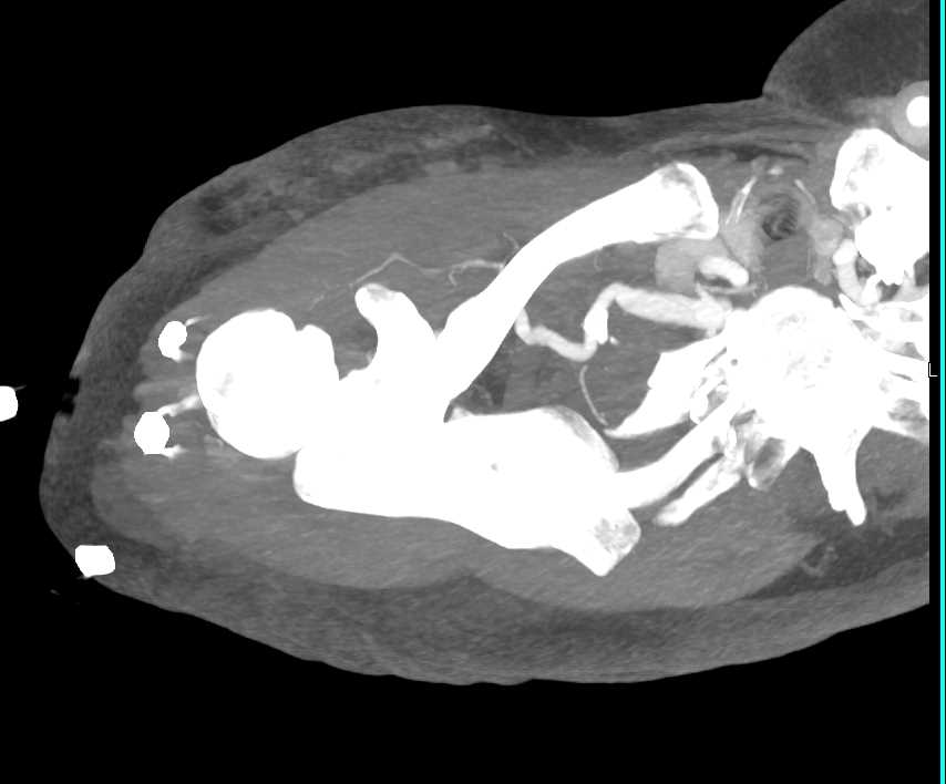 Focal Narrowing in the Right Subclavian Artery - CTisus CT Scan