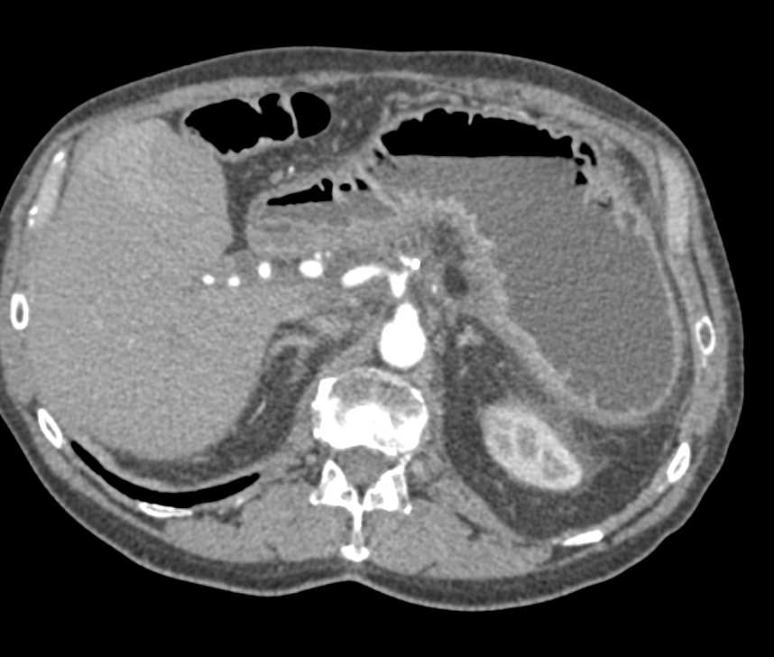 Endovascular Stent Repair of Type B Dissection - CTisus CT Scan
