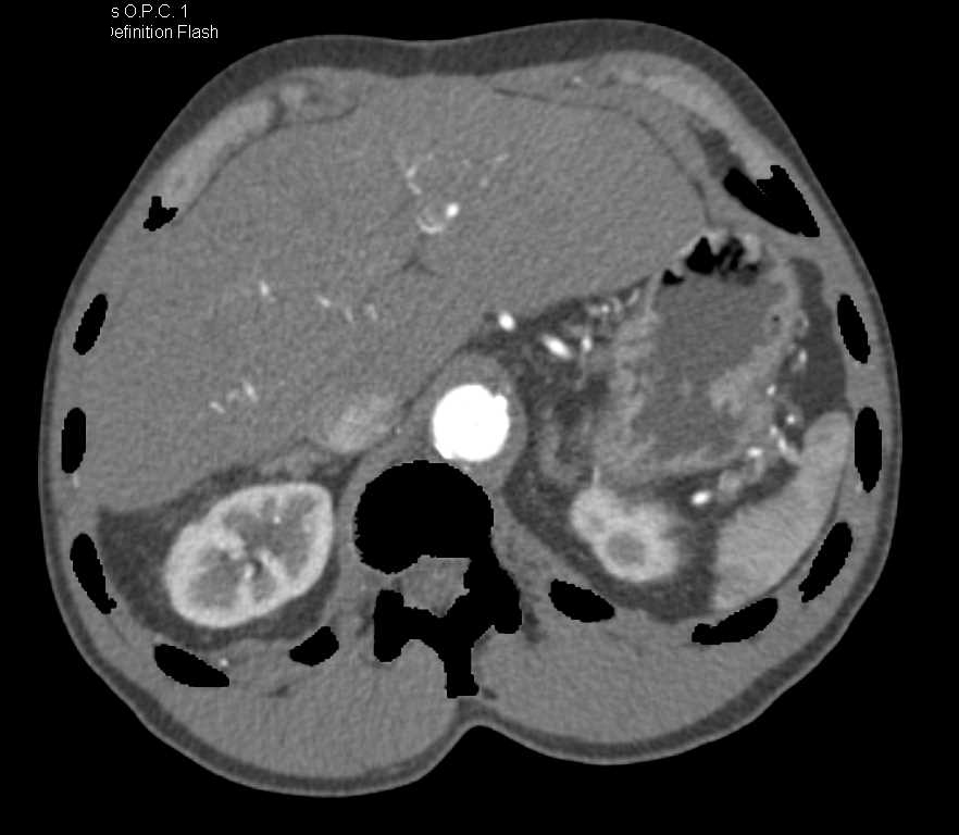 Fem-Popliteal Bypass Graft in Patient with Peripheral Vascular Disease (PVD) and Dual Energy CT - CTisus CT Scan